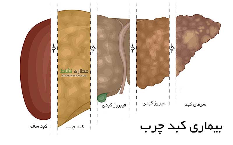 بیماری کبد چرب