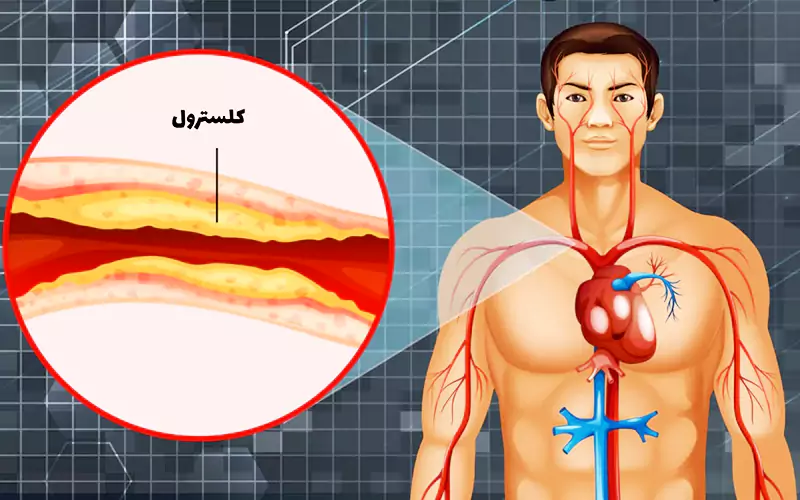 قاتل کلسترول بالا چیست